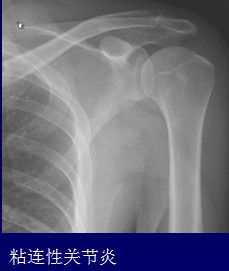 【专业篇】肩关节影像应用与解剖