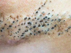 常于出生时或出生后不久即出现黑头粉刺样丘疹,由充以色素性角质栓的