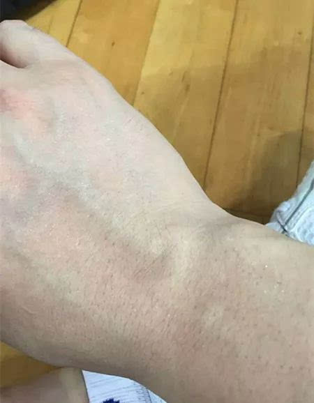 罗胤朋友圈发图拼到手腕受伤.