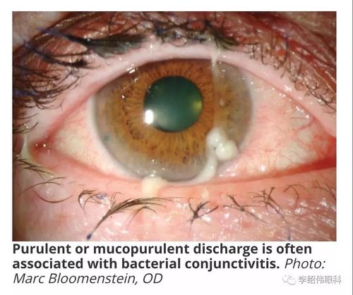 图二,过敏性结膜炎除了眼红流泪以外,还会有比较明显的瘙痒,眼睑也会