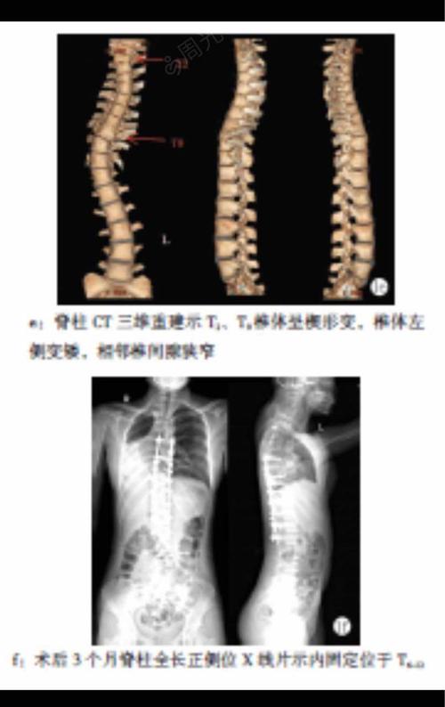 先天性脊柱侧凸伴右位心