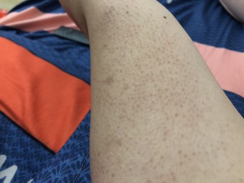 突然发现自己两个手臂成这样是毛囊炎吗