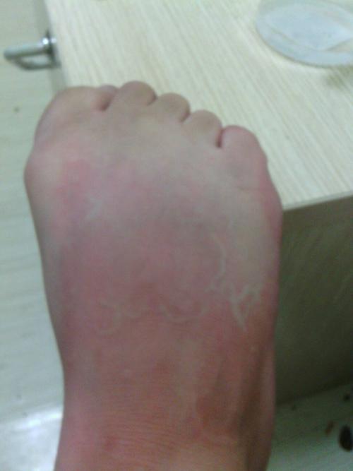 今天突然脚过敏,有经验的医生帮看看.很痒.