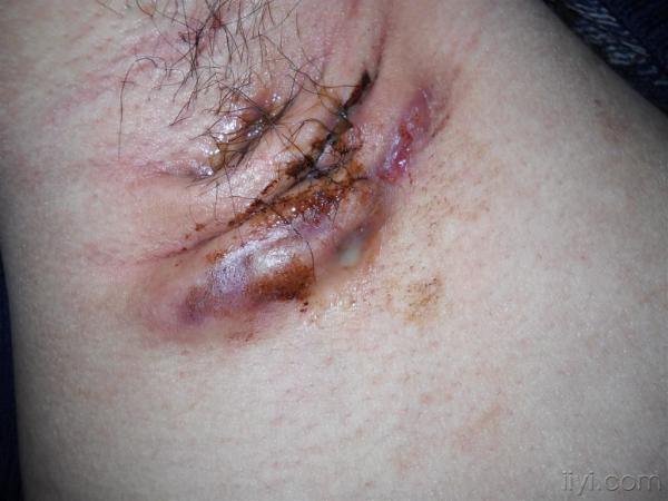 化脓性汗腺炎