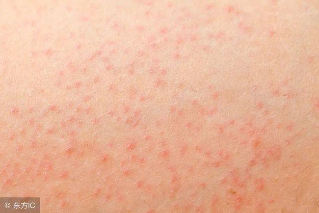 皮肤毛囊炎会有哪些症状表现常会伴有瘙痒与疼痛