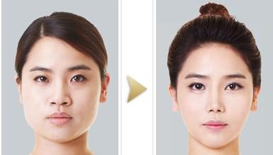 磨腮骨手术多少钱