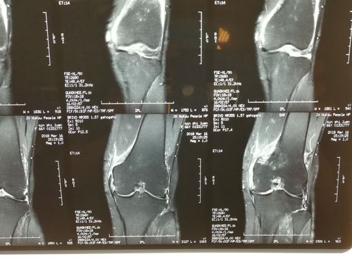 膝内侧副韧带(mcl)损伤