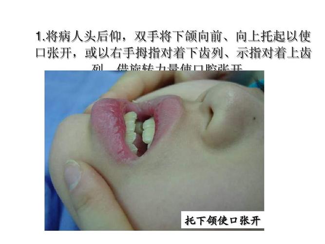 将病人头后仰,双手将下颌向前,向上托起以使 口张开,或以右手拇指对着