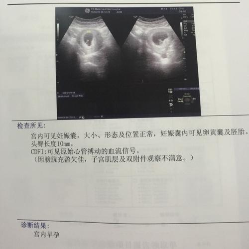 怀孕7周,豆丁宝宝的第一张照片,好开心!