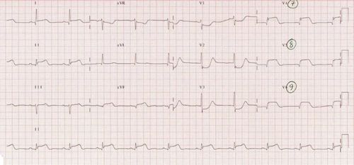 心电图示例 以下表现提示后壁心梗 v2-v3导联st段压低; v2-v3导联有