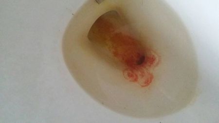 现在我担心的不是内痔的问题害怕是直肠癌!因为我大便次数比较多!