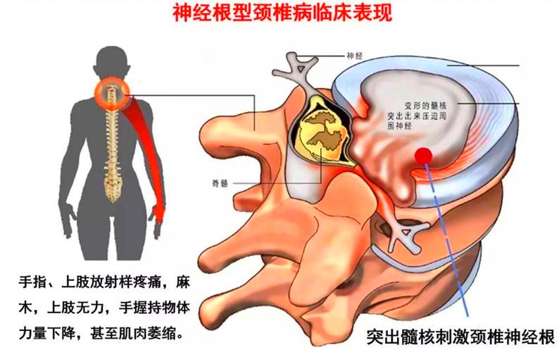 同,颈椎病它其中有两个重要的分型,就是神经根型颈椎病和脊髓型颈椎病
