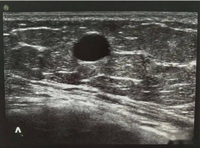 乳腺超声怎么看今天教你来判断