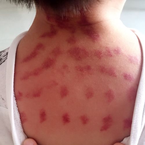 梅子的影像生活d6-挤痧