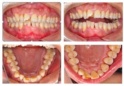 慢性牙周炎伴牙槽骨吸收 口腔护理习惯改善牙周状况