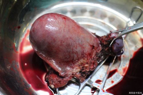 术中影像及切除的子宫