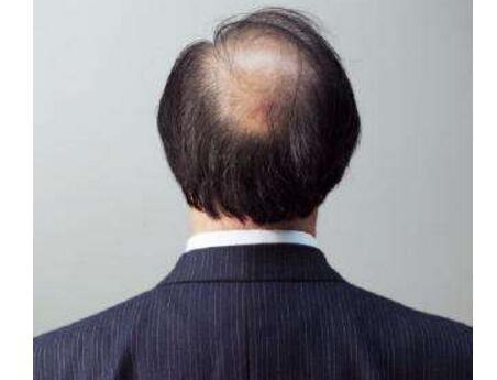 男士脱发治疗方法 3招帮助男人远离脱发噩梦