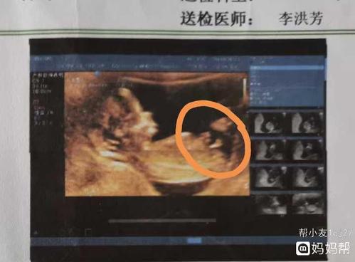 生完才发现nt可以看出男女,准确度很高,我可以帮你们看下