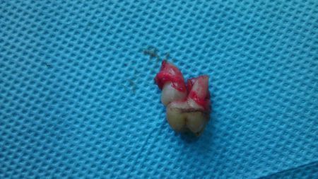 今天拔掉了右上第七颗和第八颗牙,不知道第八颗牙齿该