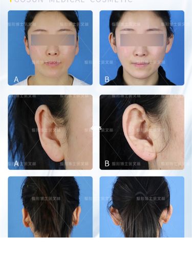 贴发耳贴面耳贴脑耳