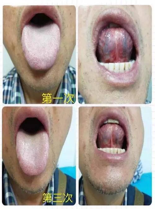 李氏砭法|糖尿病克星
