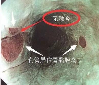 barrett食管背后的故事(2):真假巴雷特