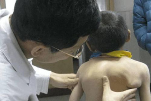 小孩驼背真可怕,罪魁祸首居然是家长,你还敢这样做吗?