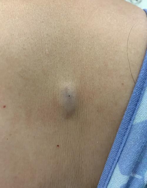 你身上长过这个吗?这是一位患者后背的所谓粉瘤,医学