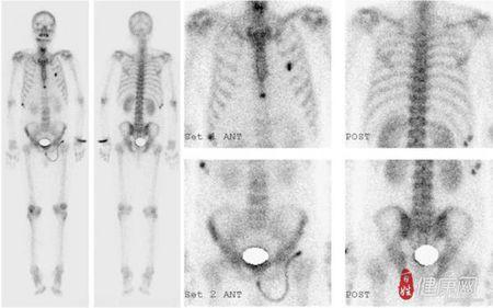 骨扫描的全身骨扫描