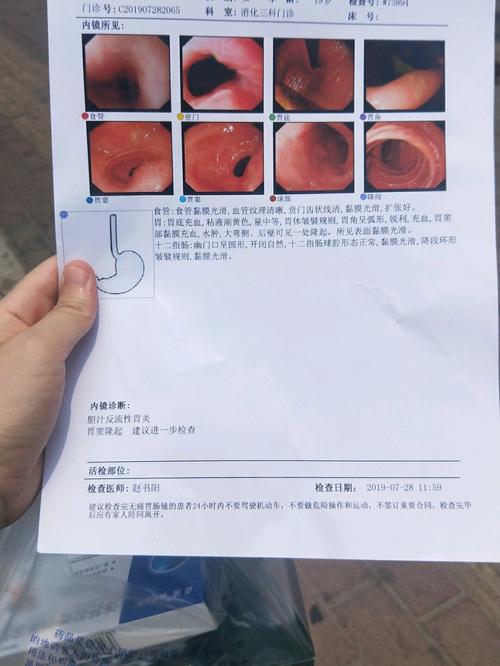 无痛胃镜_饺子_胃溃疡_慢性胃炎_医疗健康_医疗健康