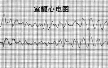 室颤,患者,李峰,胸闷,心肌梗塞,心梗