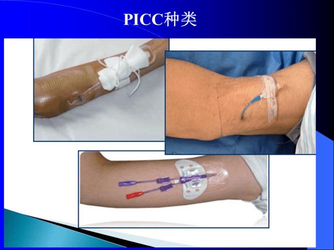 《中心静脉置管维护》ppt课件