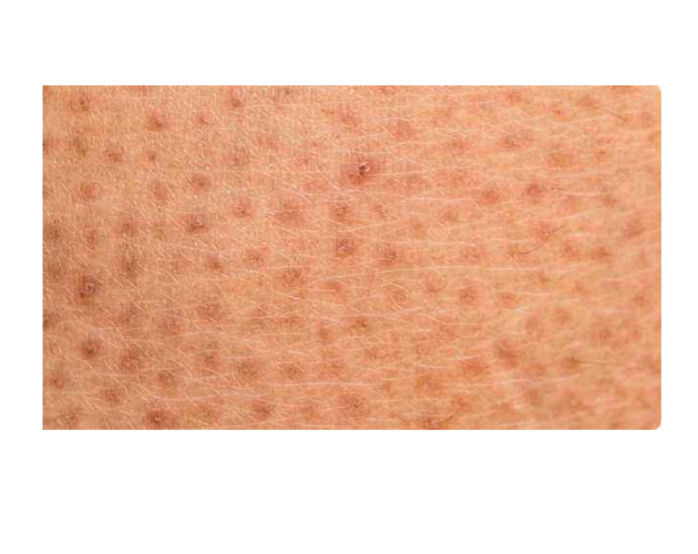 毛周角化症的症状