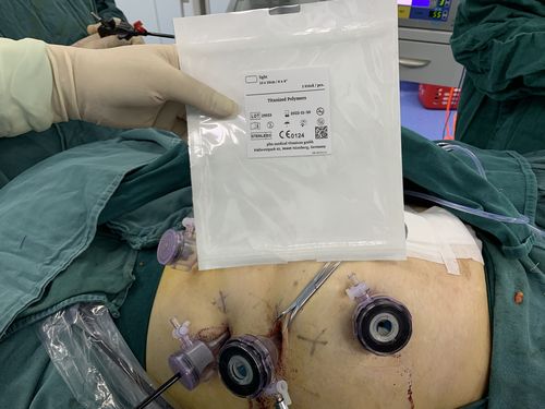 写美篇 放置第一张补片 放置第二张补片 术后5天,造瘘口排气排便