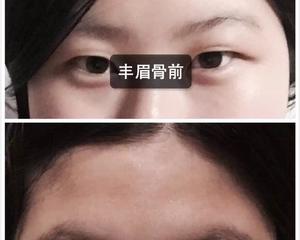 钻漾丰眉骨效果好吗?
