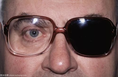 复视是个什么鬼?到底要看哪个科?