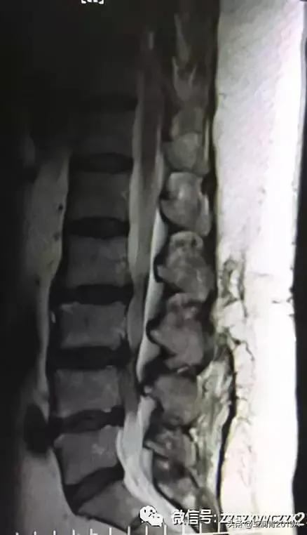 弯腰捡东西腰痛腿麻大小便失禁竞是腰椎间盘髓核脱出惹的祸