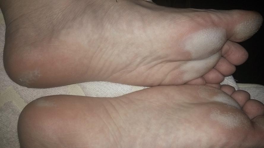 脚底板发白,还有一个小坑一个小坑的,附图,求神人解答