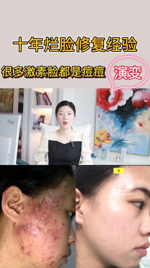 教你避雷很多激素脸都是来自痘痘的演变