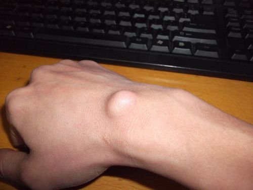 手上生了个瘤子不知道属于什么类型我该怎么办