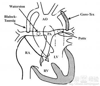 这种疾病主要就是室间隔缺损,肺动脉狭窄,主动脉骑跨跟右心室肥厚,而