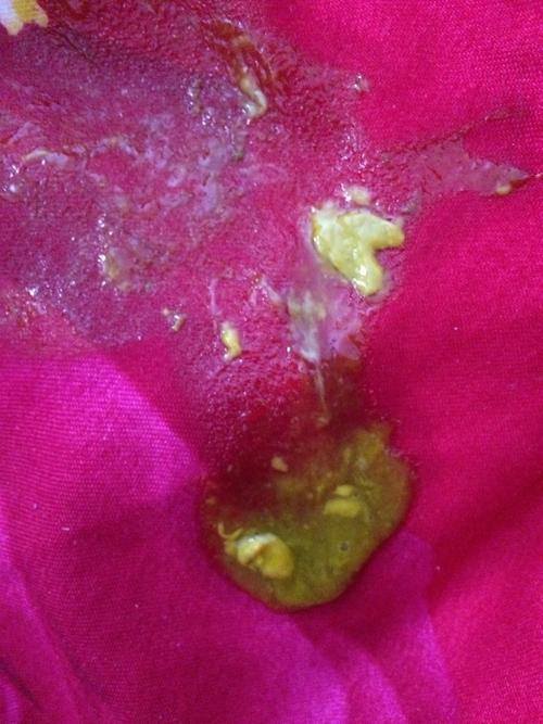 宝宝拉屎有的像鼻子一样这是怎么了?
