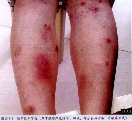 66荨麻疹性血管炎67鱼鳞病68毛发角化病69汗孔角化症70掌跖角化病71