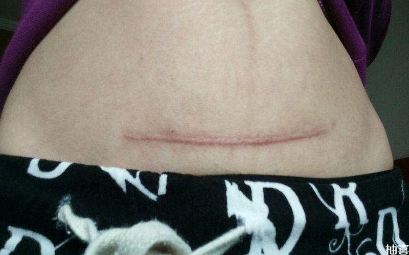 如果刀口护理比较好,疤痕就不会太明显,如果在剖腹产之后,刀口护理不