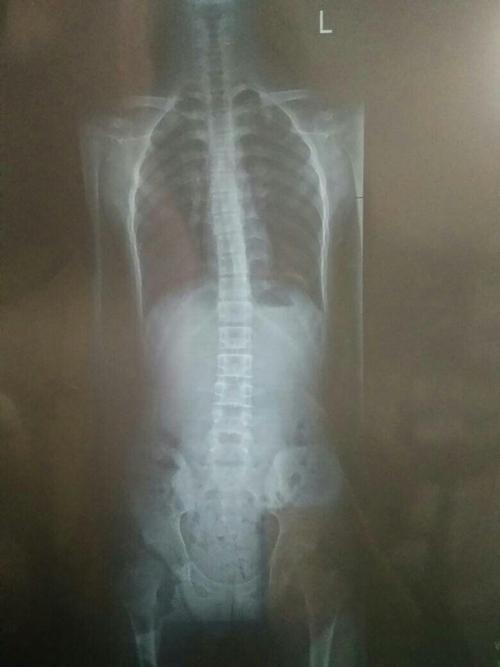 的腰比左边的要往内凹,左边就是一条直线,而且我有大约5度的脊椎侧弯