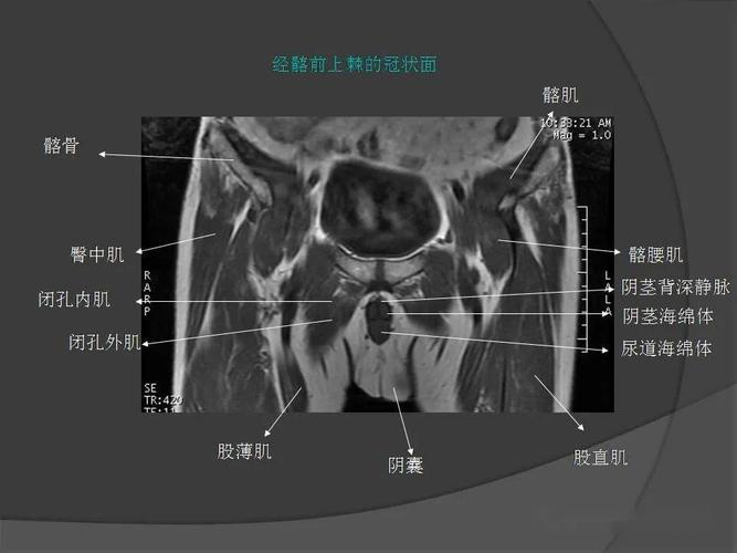 骨盆肌肉mri断层解剖