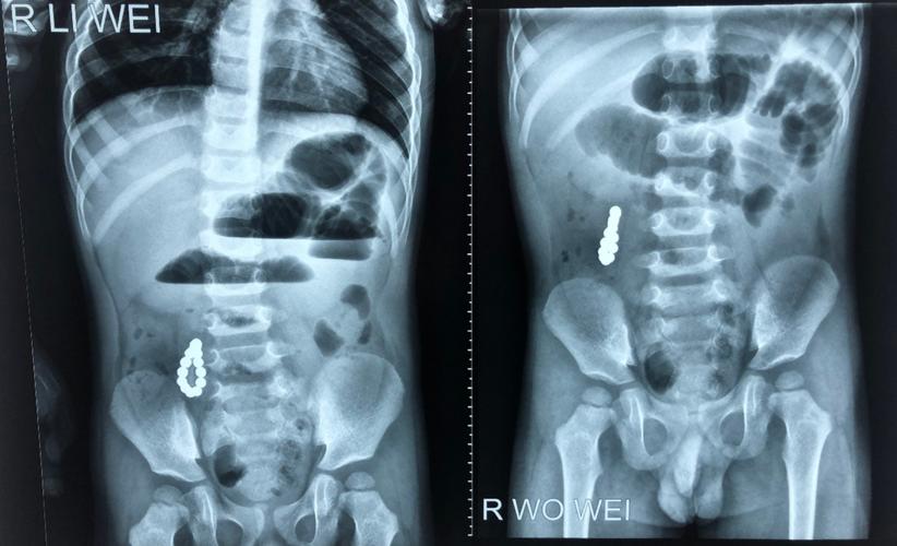 患儿的腹部平片