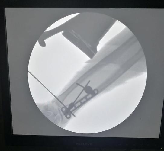 手术演示:盖氏骨折微创钢板接骨术