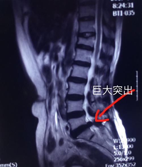 mri矢状面可见腰5/骶1椎间盘巨大突出