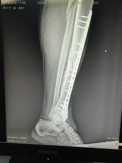 胫腓骨粉碎性骨折,小切口植入加长钢板,告别传统大切口